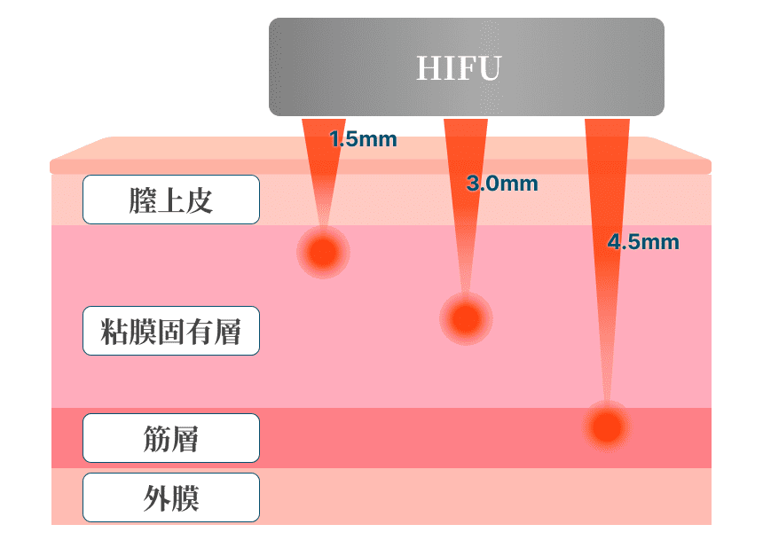 HIFU層別照射イメージ