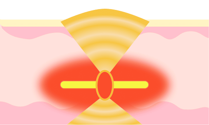 SUPER HIFUV リニア照射