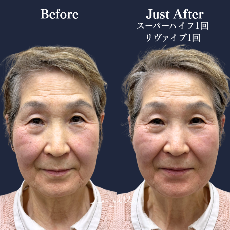 スーパーハイフRT +リヴァイブ No.343