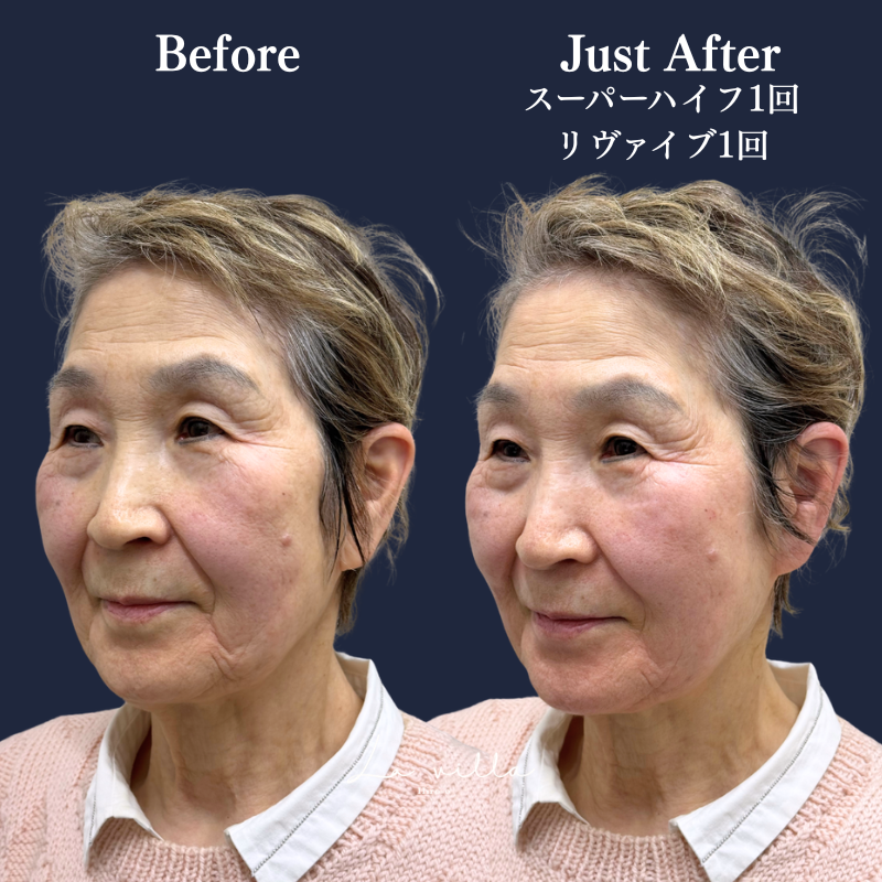 スーパーハイフRT +リヴァイブ No.343