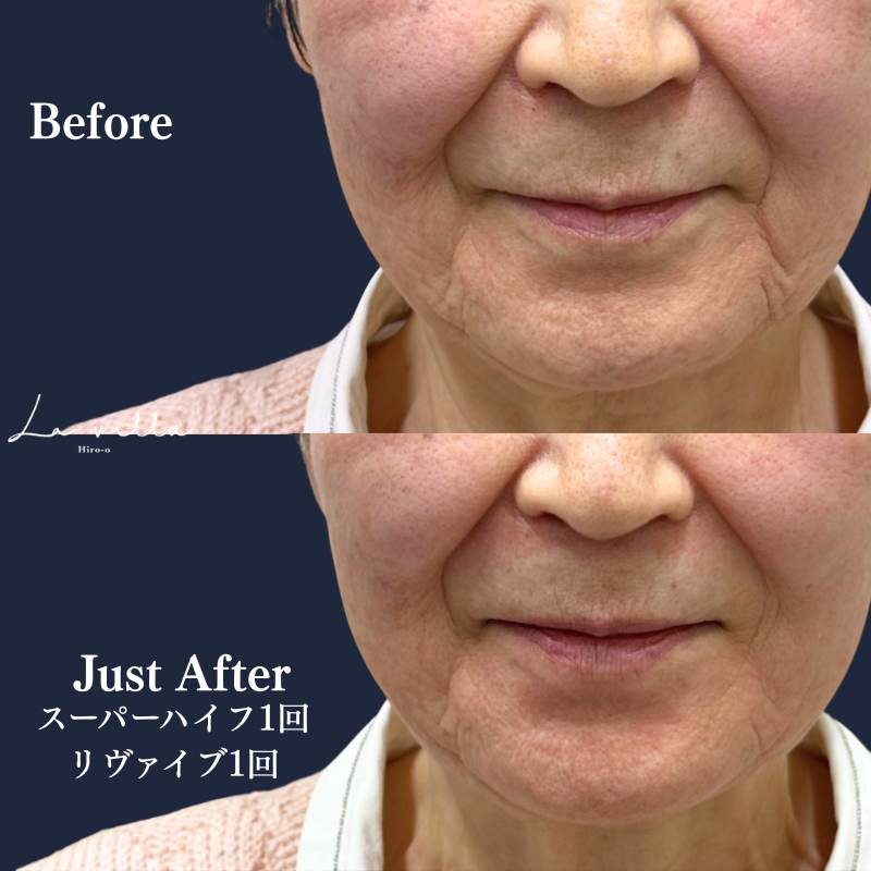 スーパーハイフRT +リヴァイブ No.343