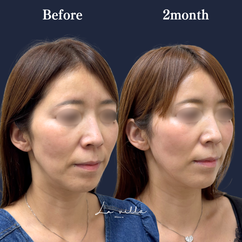 糸リフト  No.347