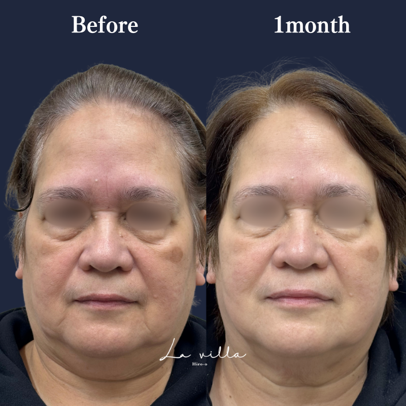 ブナジュ＋スーパーハイフRT No.351