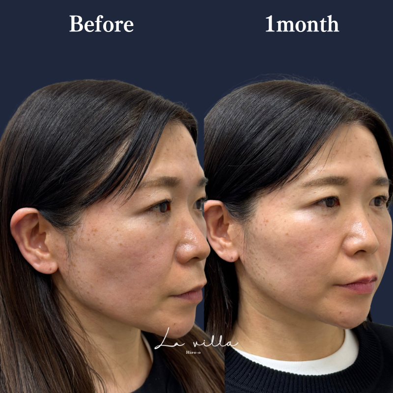 ブナジュ＋スーパーハイフRT No.352