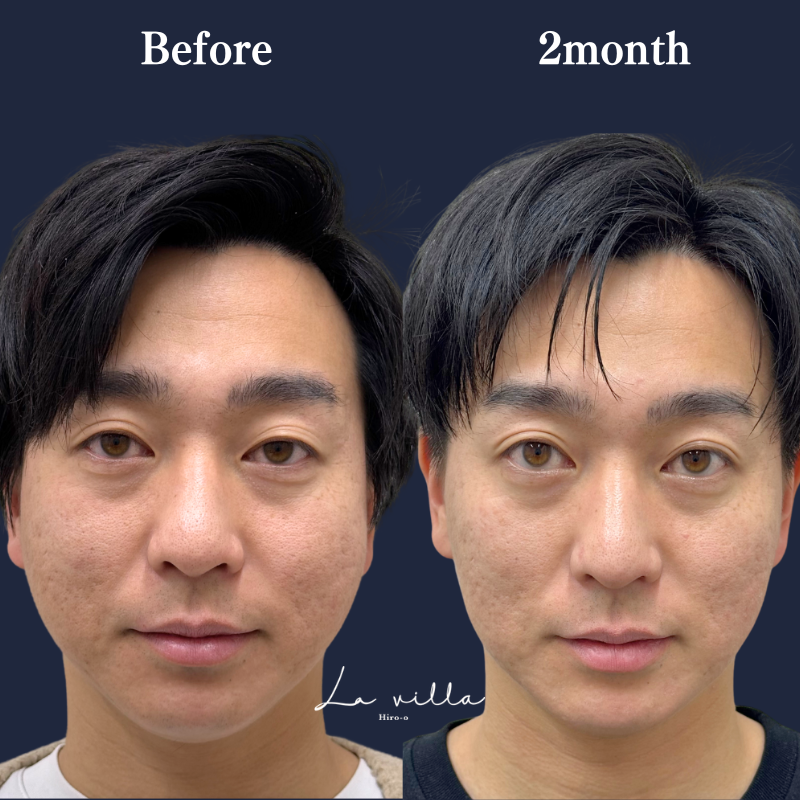 スーパーハイフRT +リヴァイブ ＋ブレッシングNo.358