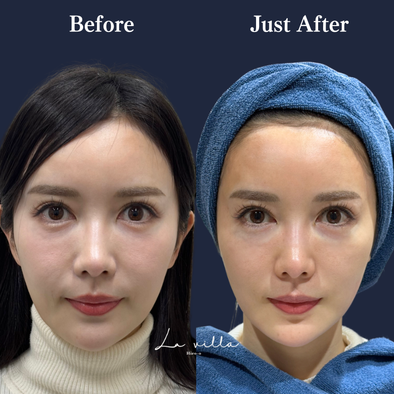 スーパーハイフRT No.360