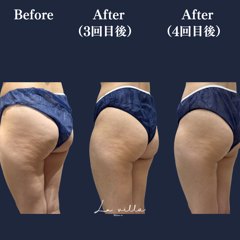 リヴァイブ(ボディ)No.362