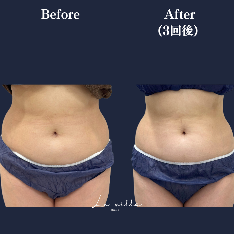 リヴァイブ(お腹)No.363