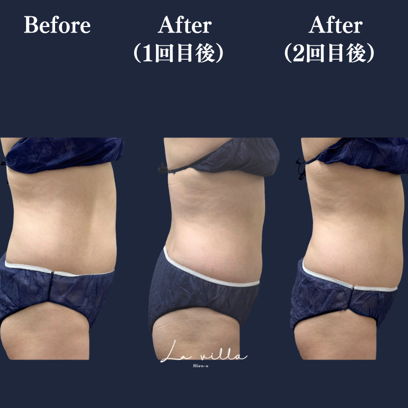 リヴァイブ(お腹)No.364