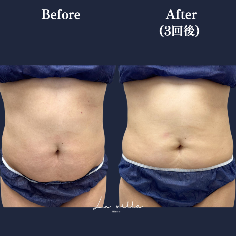 リヴァイブ(お腹)No.365