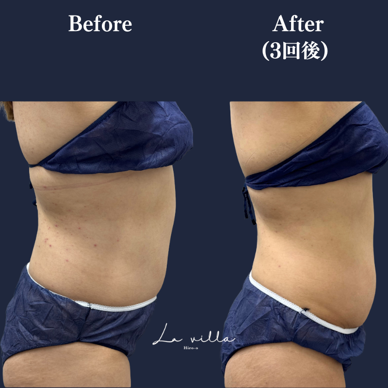 リヴァイブ(お腹)No.365