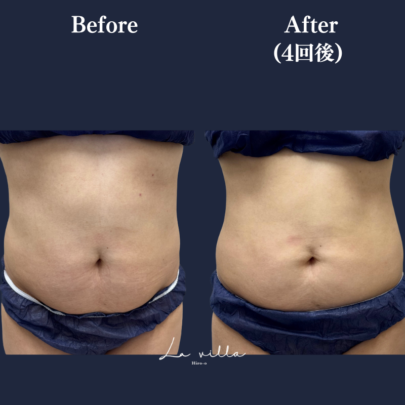 リヴァイブ(お腹)No.366