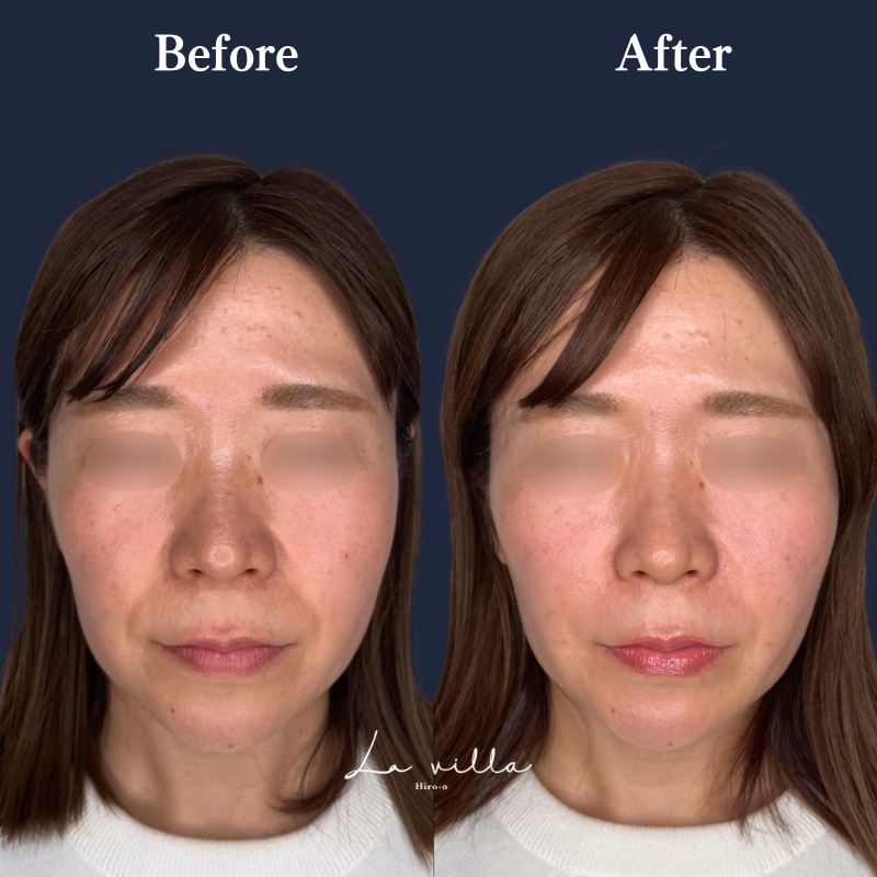 頬＋ゴルゴライン＋ほうれい線ヒアルロン酸  No.367