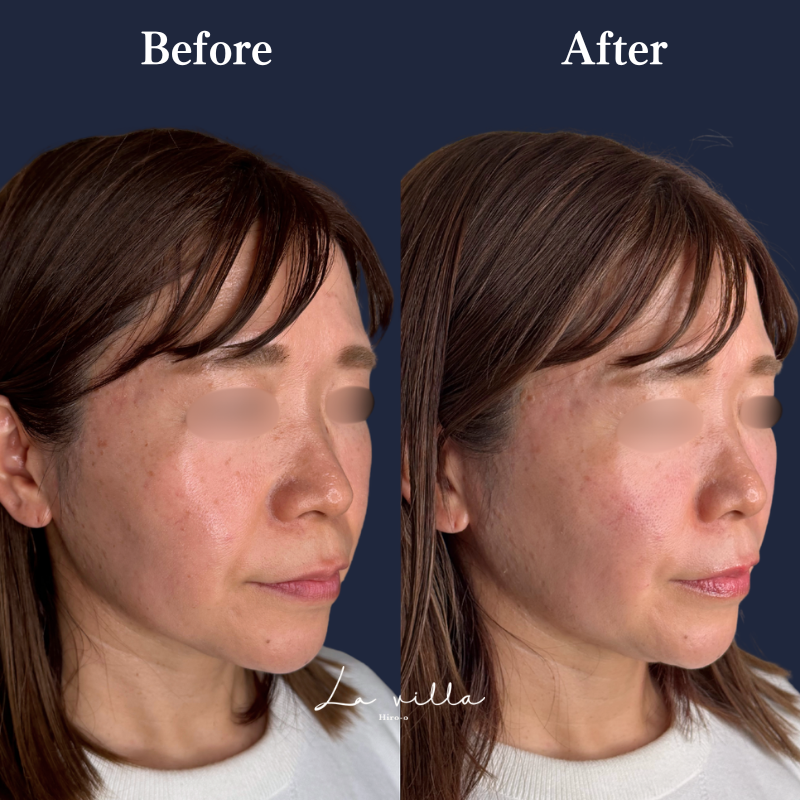 頬＋ゴルゴライン＋ほうれい線ヒアルロン酸  No.367