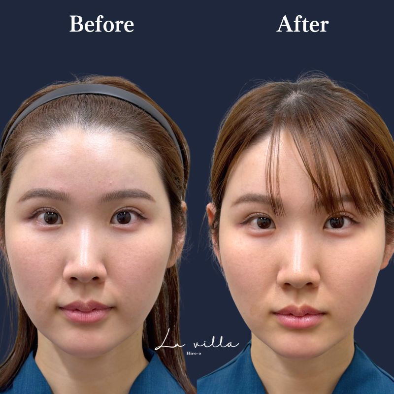 涙袋ヒアルロン酸 No.368