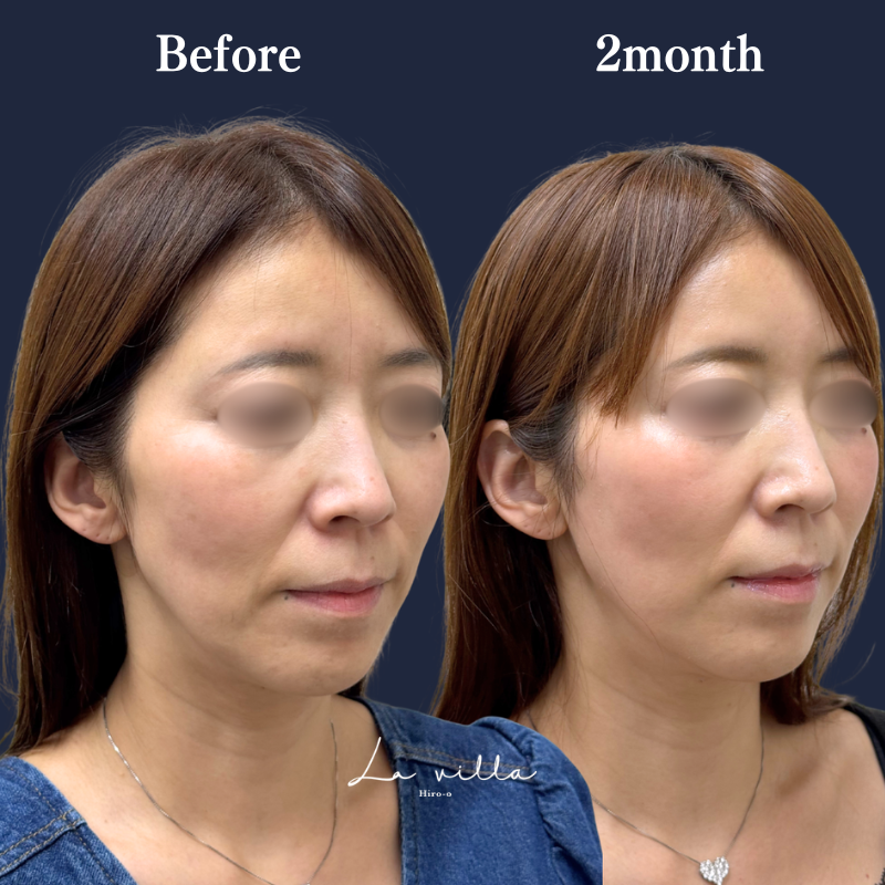 糸リフト  No.369