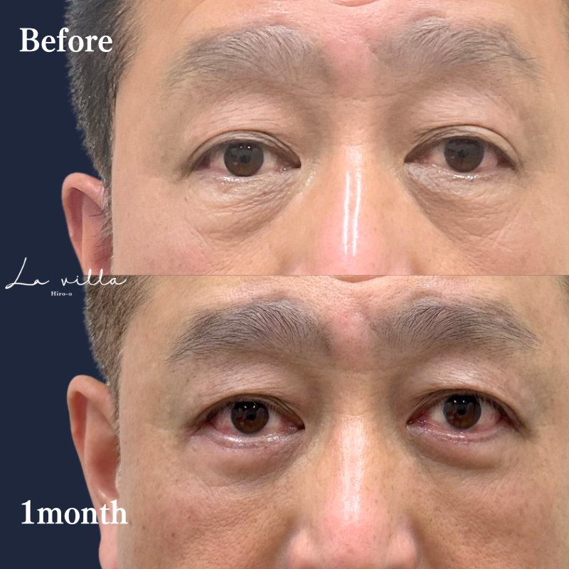 下眼瞼除皺術 No.370