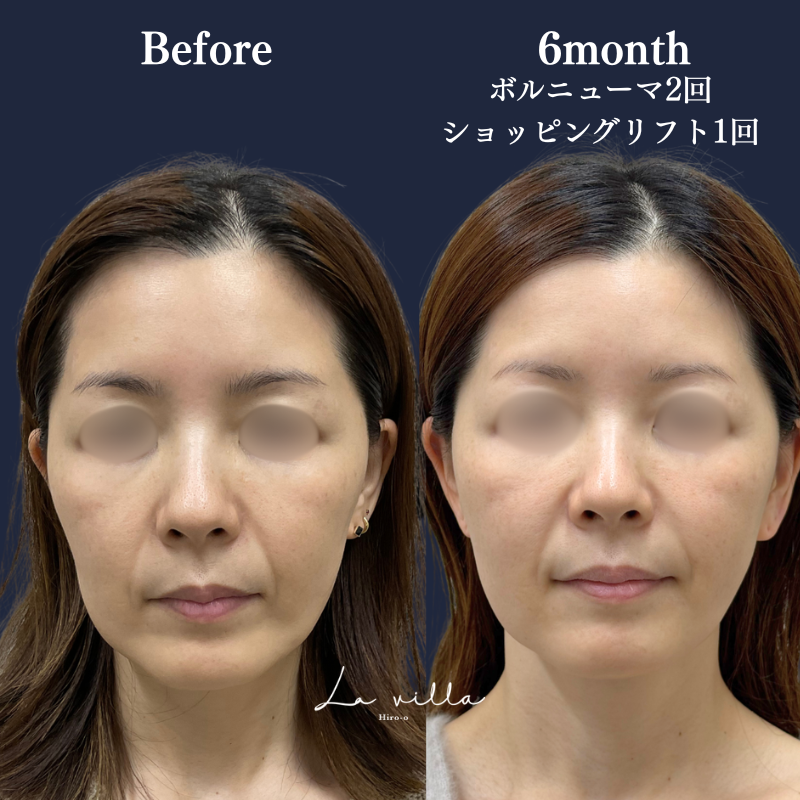 ボルニューマ＋ショッピングリフト No.371