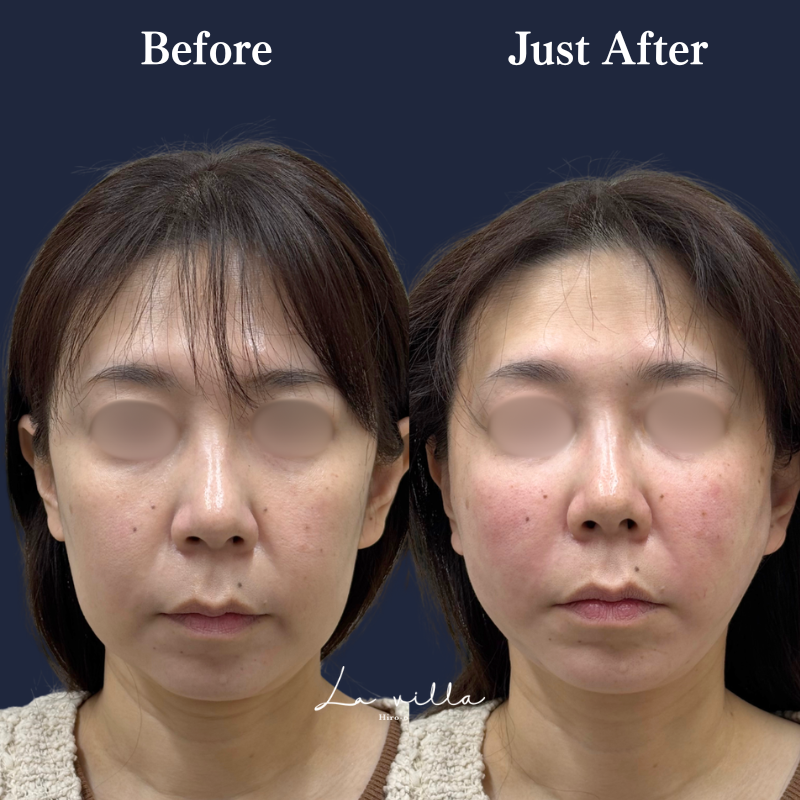 糸リフト＋ショッピングリフト No.372