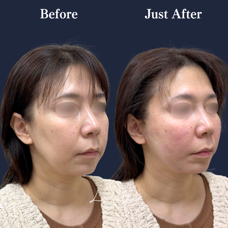 糸リフト＋ショッピングリフト No.372