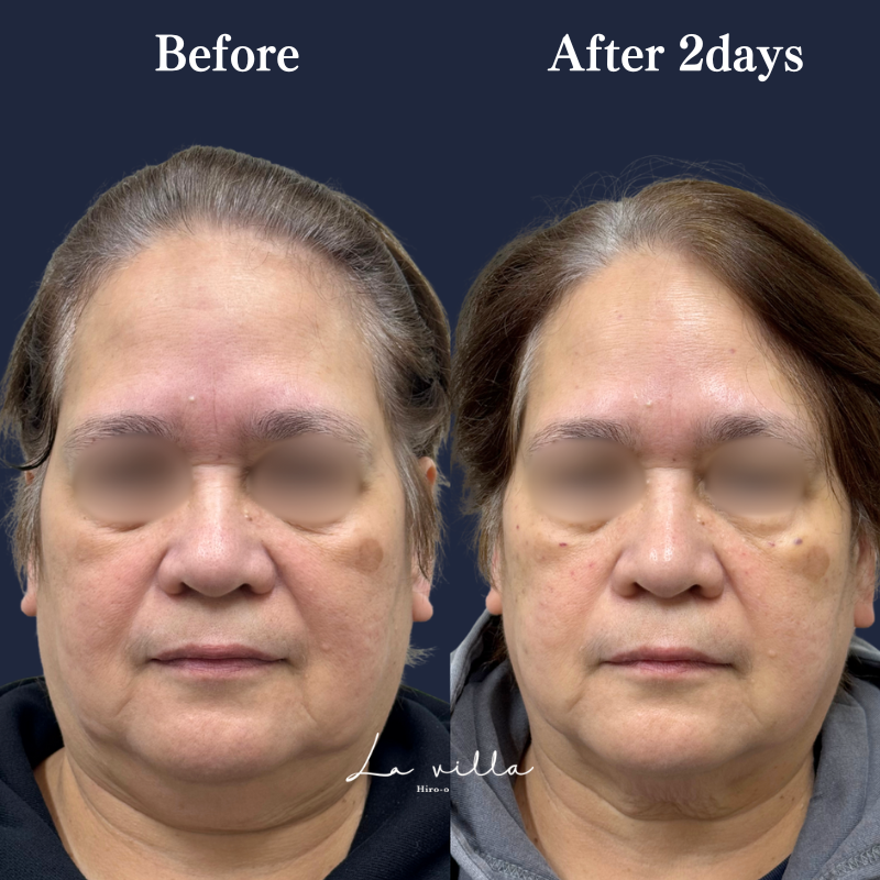 スーパーハイフRT No.330