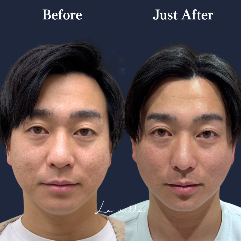 スーパーハイフRT +リヴァイブ No.331