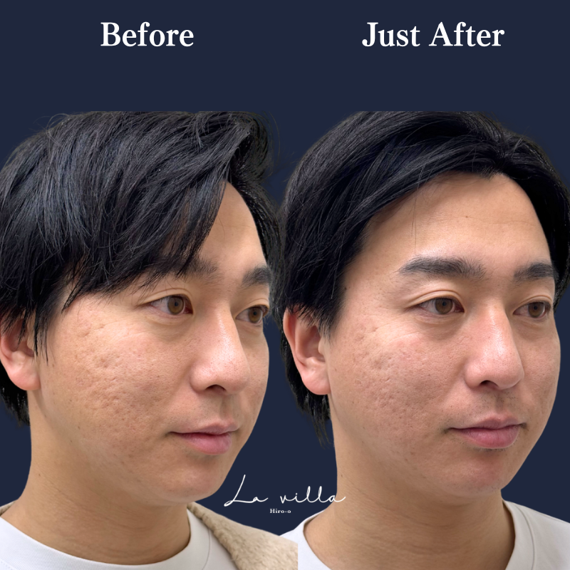 スーパーハイフRT +リヴァイブ No.331