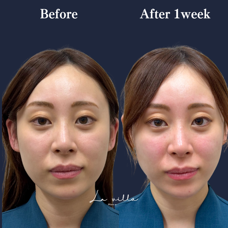 スーパーハイフRT No.332