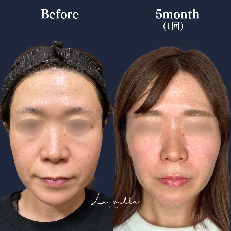 ボルニューマ No.335