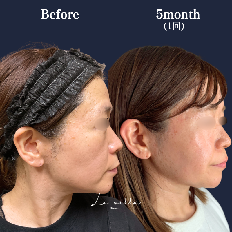 ボルニューマ No.335