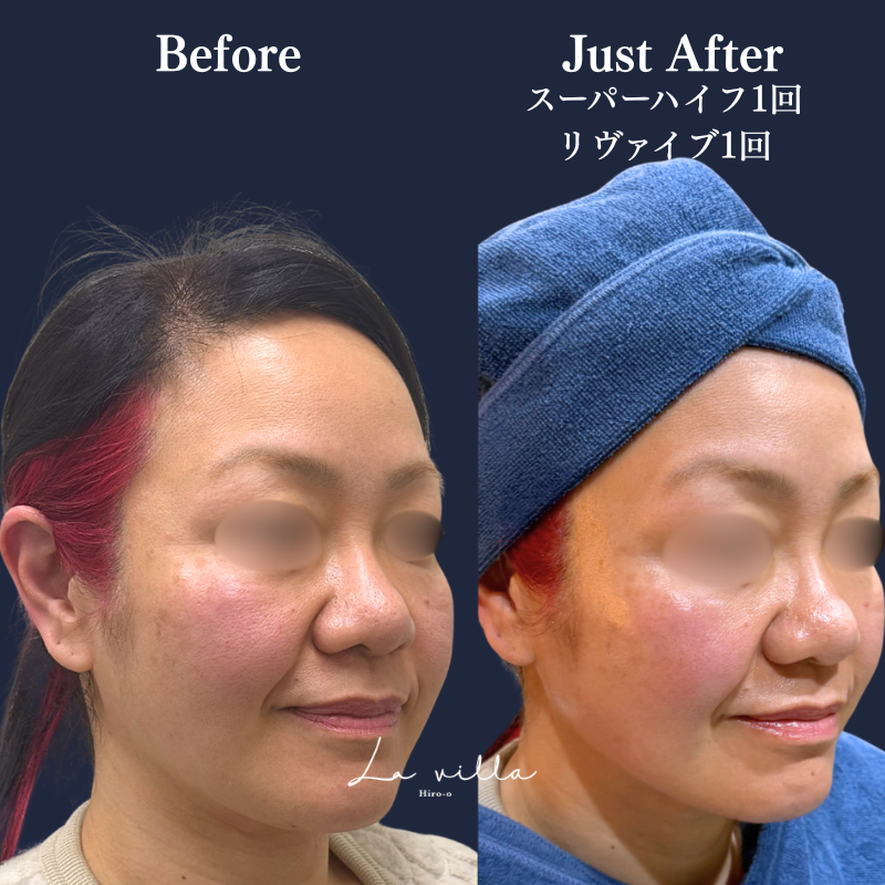 スーパーハイフRT +リヴァイブ No.339