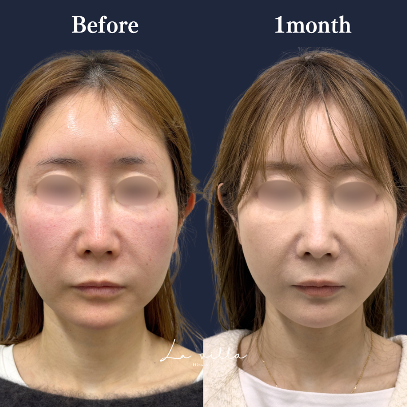 糸リフト＋ショッピングリフト No.340