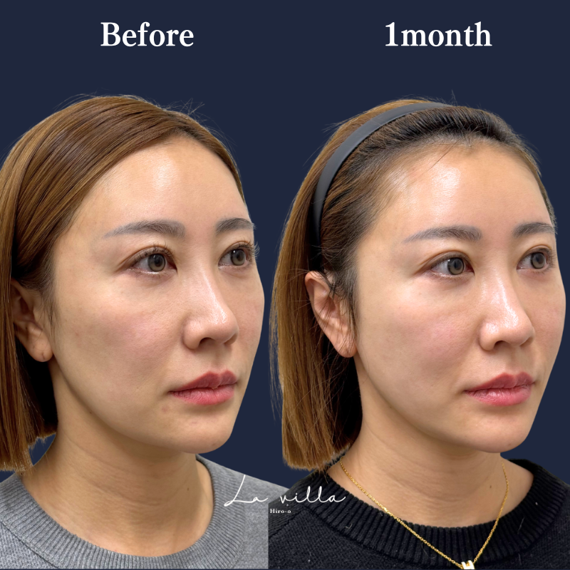 糸リフト＋ショッピングリフト No.341