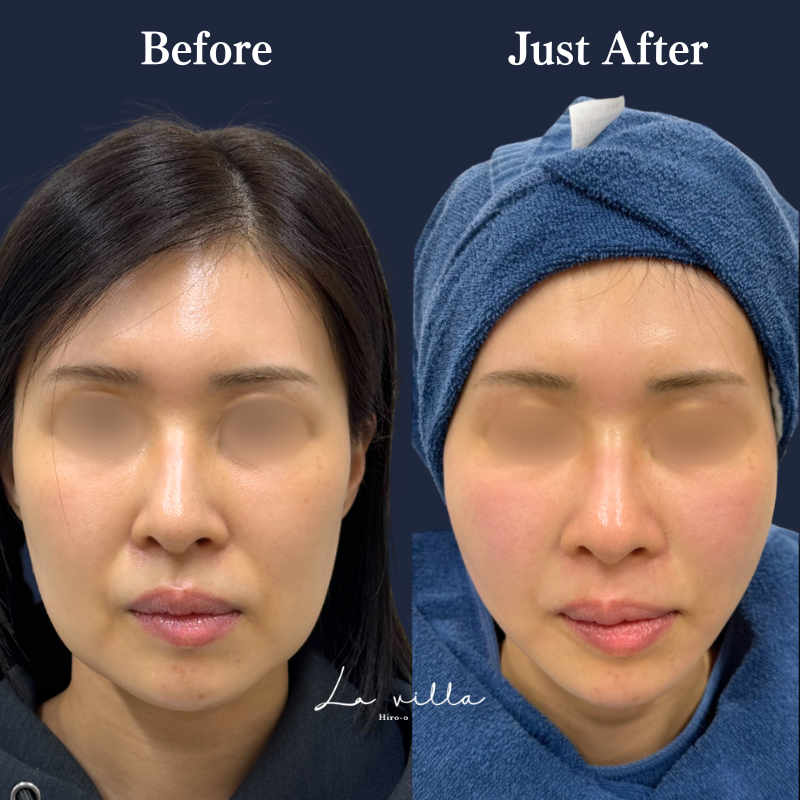 糸リフト＋ショッピングリフト No.342