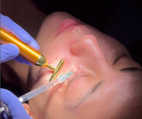 痛くない肌育注射