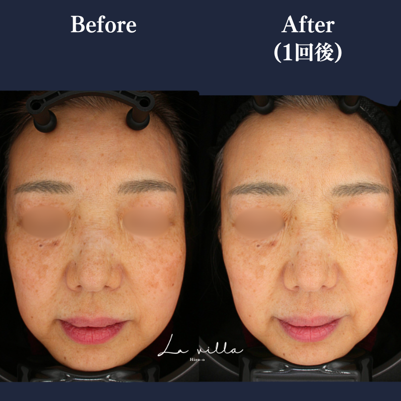 ピコトーニング+リバースピール No.385