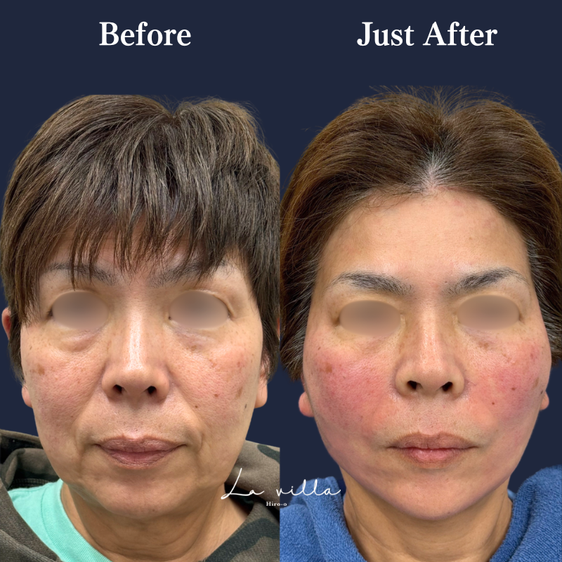 糸リフト＋ショッピングリフト No.376