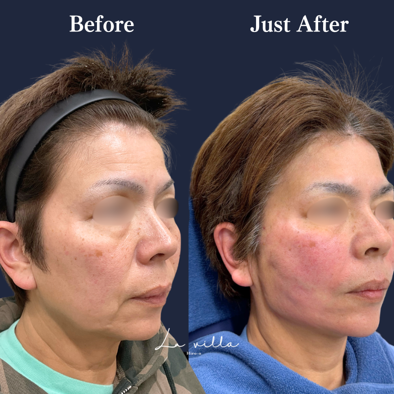 糸リフト＋ショッピングリフト No.376