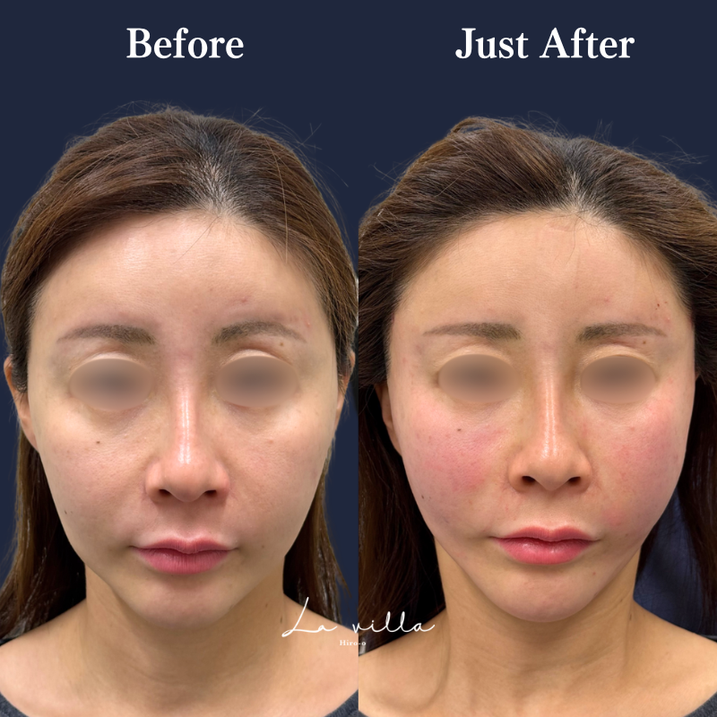 糸リフト＋ショッピングリフト No.377