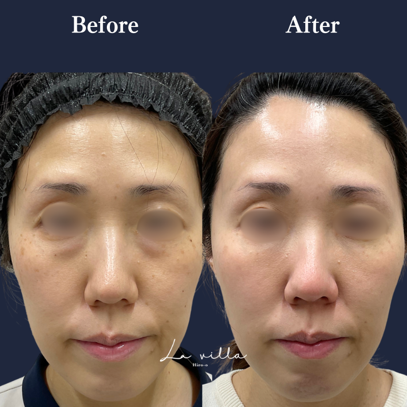 フォトフェイシャル（ステラM22）＋裏ハラム No.379