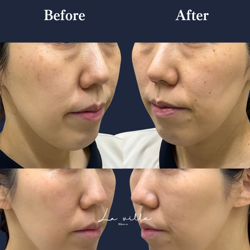 フォトフェイシャル（ステラM22）＋裏ハラム No.379