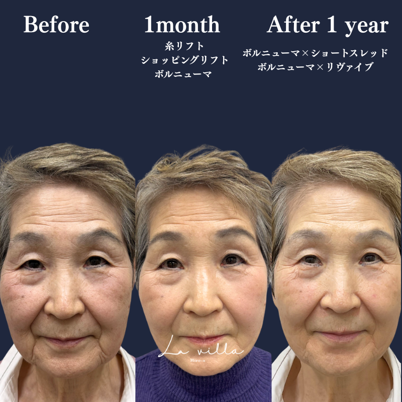 糸リフト＋ショッピングリフト＋ボルニューマ＋リヴァイブ No.382