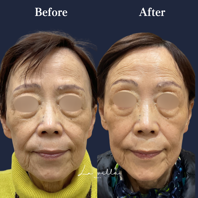 ピコトーニング+ララドクター No.383