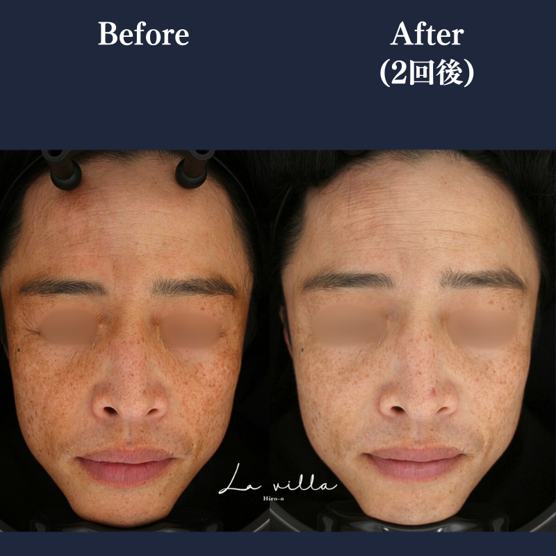 ピコトーニング+リバースピール No.384