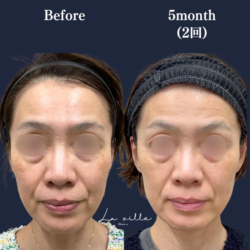 ブレッシングNo.386