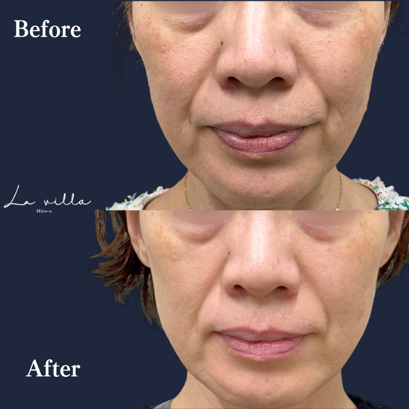 ブレッシング＋ ジャルプロスーパーハイドロNo.387