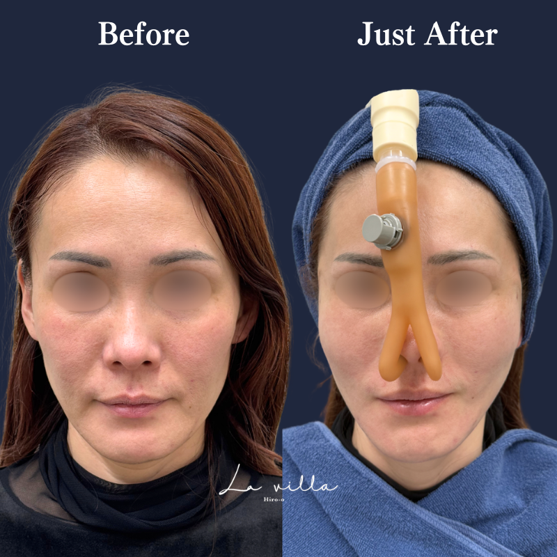 糸リフト＋ショッピングリフト No.391