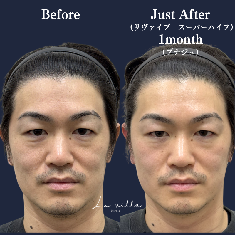 スーパーハイフRT +リヴァイブ＋ブナジュ No.392