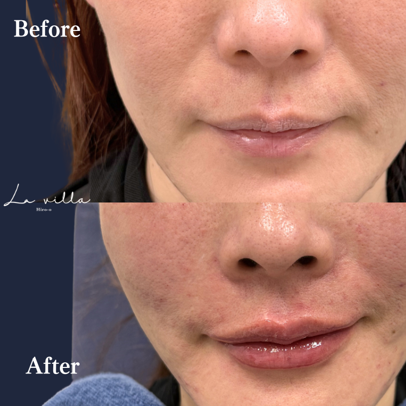 唇ヒアルロン酸  No.395