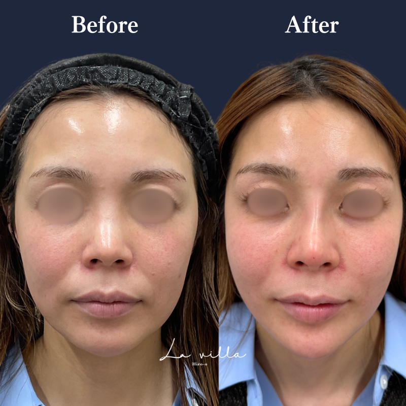 スーパーハイフRT +リヴァイブ ＋ヒアルロン酸（ほうれい線・顎・鼻）No.396